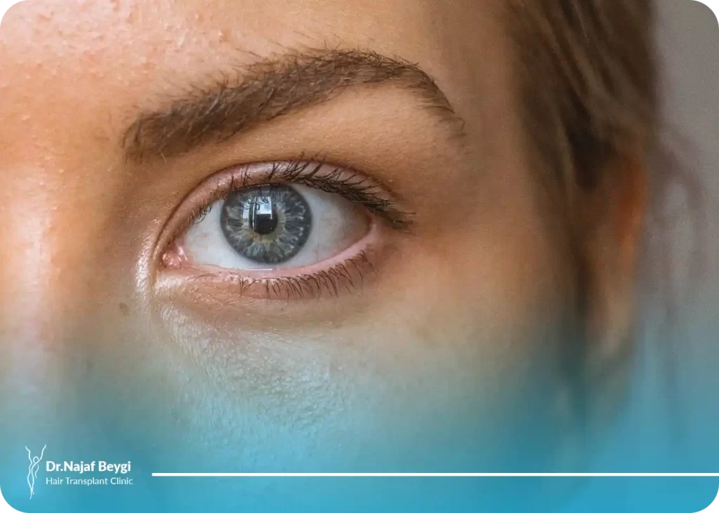 اپی کانتال چشم یا عمل درشت کردن چشم