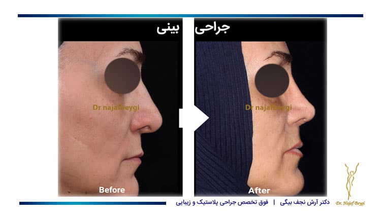 نمای نیم رخ قبل و بعد از عمل بینی یک خانم توسط دکتر نجف بیگی