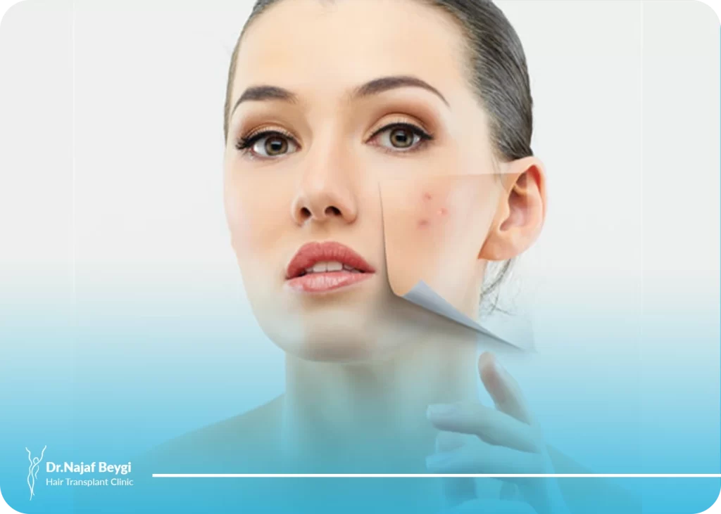 علت ایجاد جوش صورت بعد از عمل بینی و راه‌های درمان آن