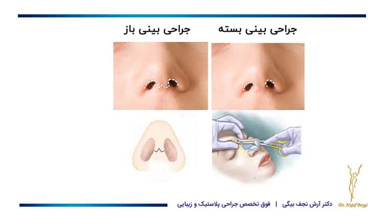 نمایش تفاوت جراحی بینی به روش باز و بسته