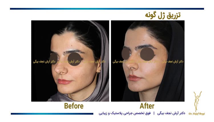 تزریق ژل گونه نمووه کار دکتر نجف بیگی قبل و بعد