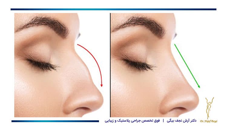نمونه قبل و بعد جراحی قوز بینی در فرد مبتلا به دیابت