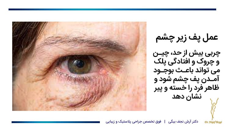 دلایل نیاز به عمل پف زیر چشم