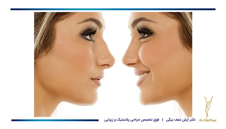 قبل و بعد از عمل زیبایی بینی در یک خانم جوان