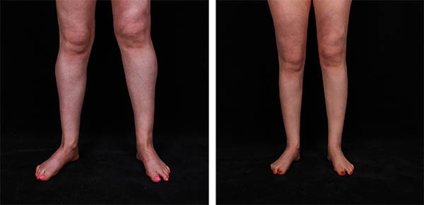 لیپوماتیک ساق پا