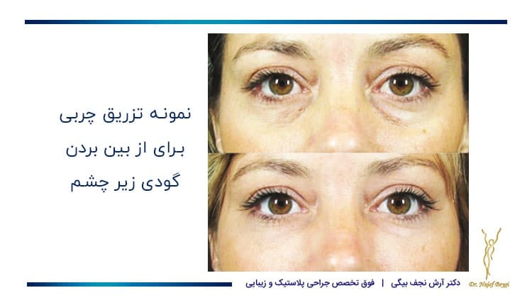 نمونه تزریق چربی زیر چشم ها برای از بین بردن گودی زیر چشم